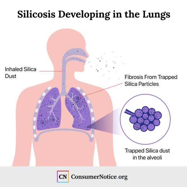 Inhaling silica dust can cause silicosis to develop in the lungs