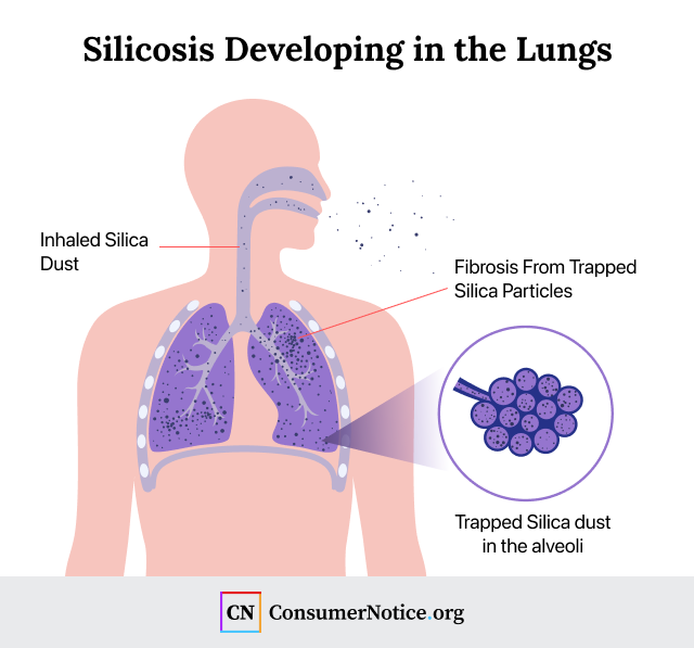 Inhaling silica dust can cause silicosis to develop in the lungs